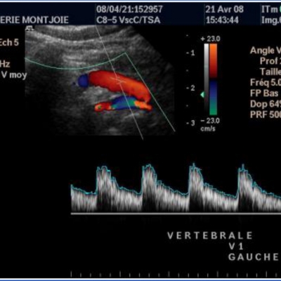 artere_vertebrale_v1_g.jpg